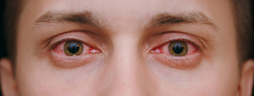 How Marijuana Affects the Eyes 